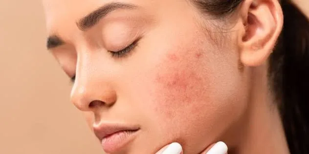 SIBO a trądzik różowaty (rosacea) – zaskakujące połączenie