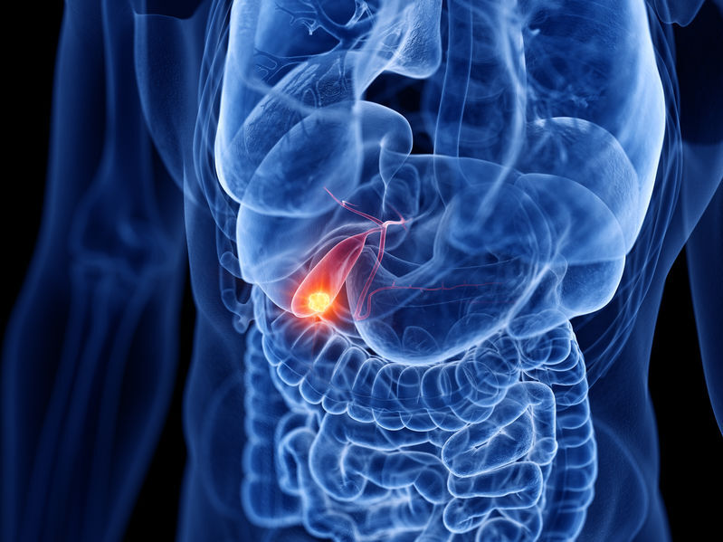 SIBO after cholecystectomy and intestinal surgeries – why does removal of the gallbladder or appendix increase risk?